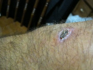 Scab on my knee (or the knee of a gorilla).