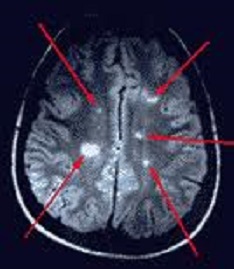 MRI brain lesions